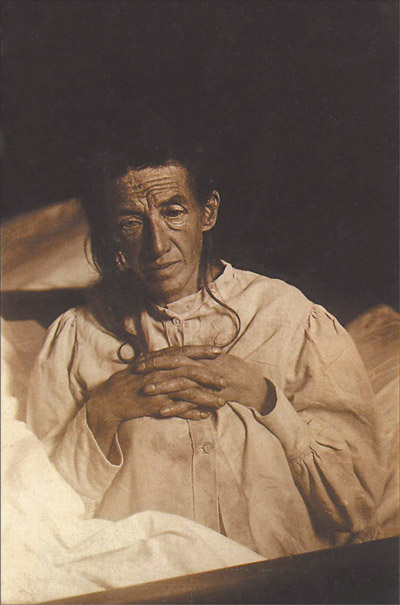 Auguste Dieter Alzheimer病人的图像