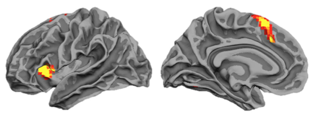 弱记忆的大脑扫描，以说明记忆改善和磁记忆法大师班失败的学习者＂width=